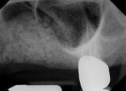 Dental X-Ray