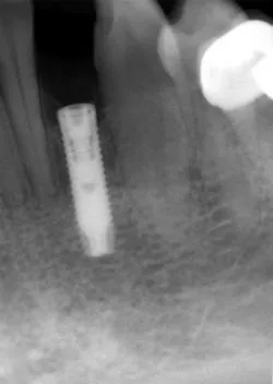 After dental treatment