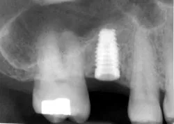After dental treatment