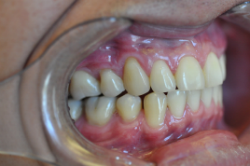 After dental treatment