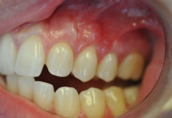 After dental treatment