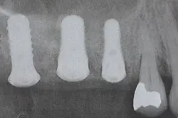 After dental treatment