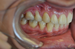 After dental treatment