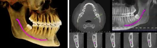 Dental X-rays